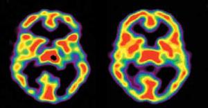 flere veck i hjärnan